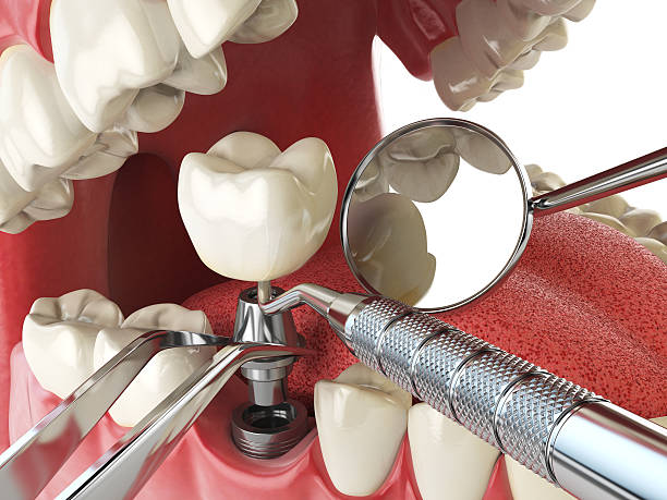 Best Emergency Treatment for Dental Infections or Abscesses in Summit Park, UT
